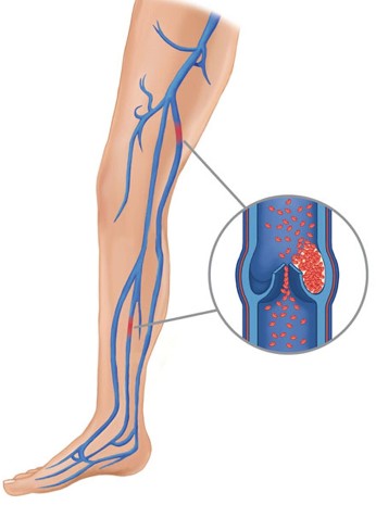 The causes of varicose veins, (1)
