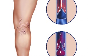 Complications from varicose veins