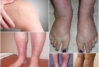 Photo of the manifestation of varicose veins on the feet