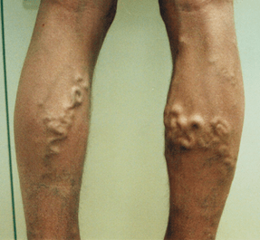 traditional methods for treating varicose veins