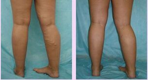 how varicose veins in the first stage manifest themselves