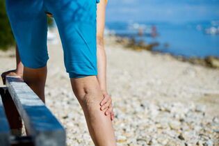 Varicose veins of the lower leg from physical activity