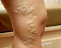 Varicose veins on the lower legs during pregnancy