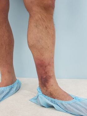 complications from varicose veins in men