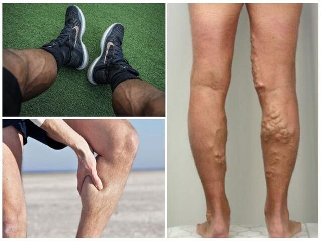what does varicose veins look like on men's legs