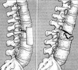 Injury to the lumbar spine
