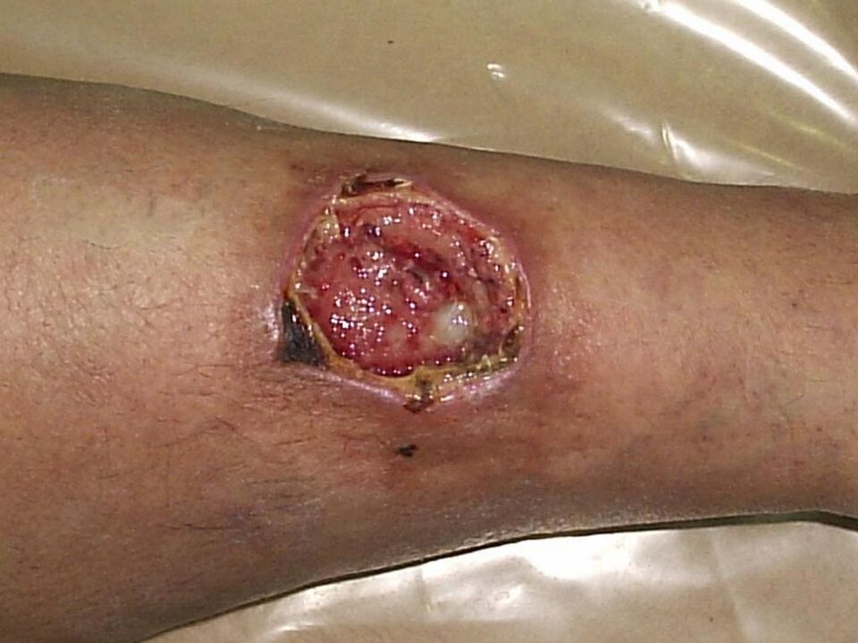 trophic ulcers with advanced varicose veins