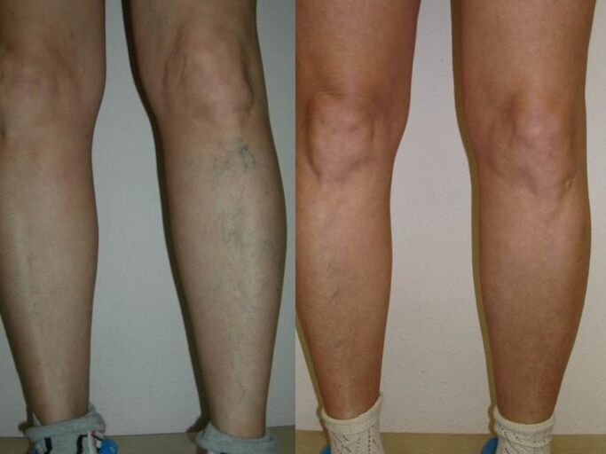 legs before and after laser treatment of varicose veins