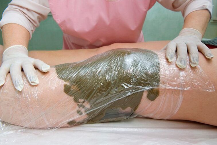 wrapping clay against varicose veins