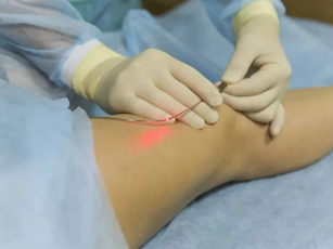 The laser treatment of the varicose veins