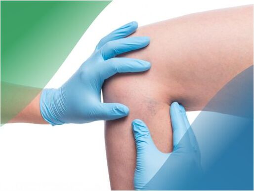 The phlebologist examines the lower part of the leg affected by varicose veins