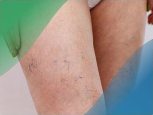 The vascular network in the legs is one of the symptoms of varicose veins