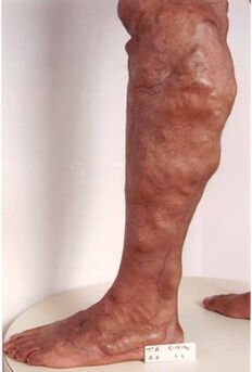 Manifestations of chronic venous insufficiency in the lower limbs