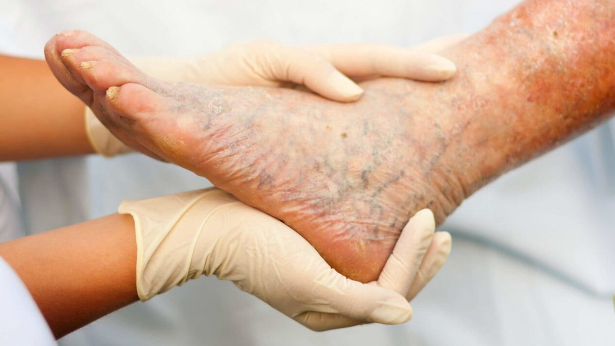 Phlebologists deal with the treatment of varicose veins in the legs