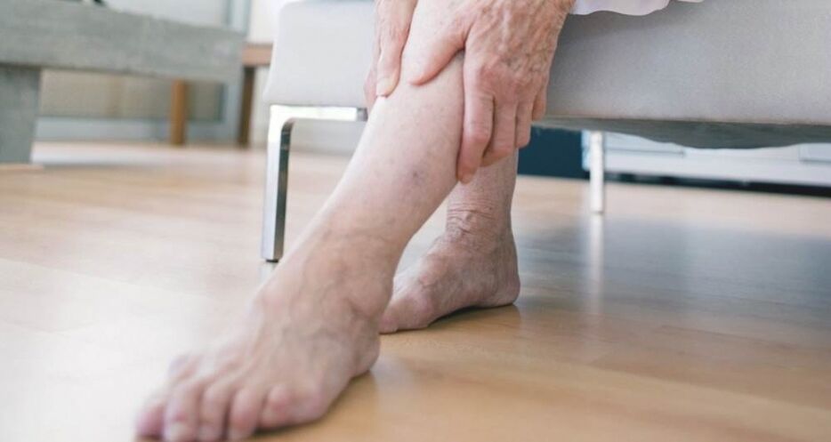 Varicose veins in the lower part of the leg caused by damage to the venous valve