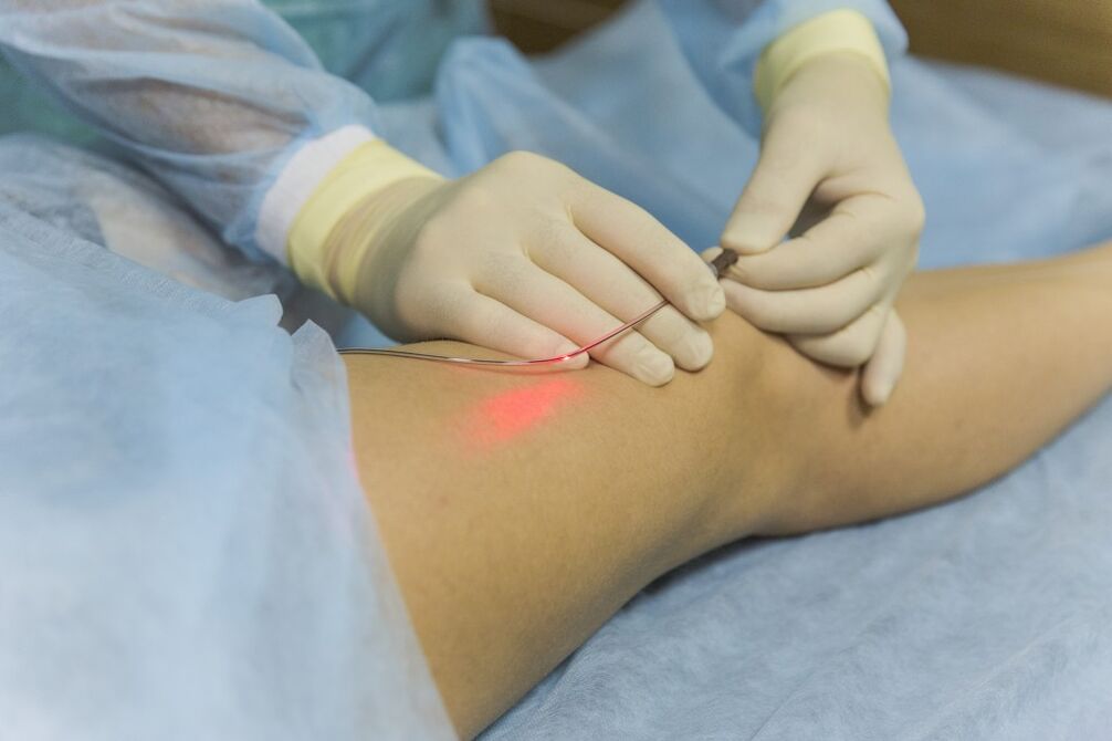 Laser treatment of varicose veins on the lower leg