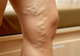 Knotted veins on women's legs