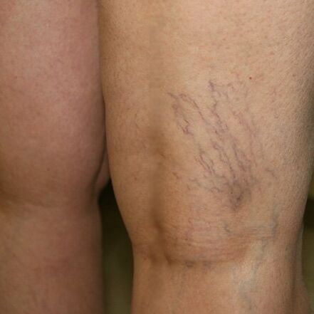 Vein mesh on the lower leg is a sign of varicose veins