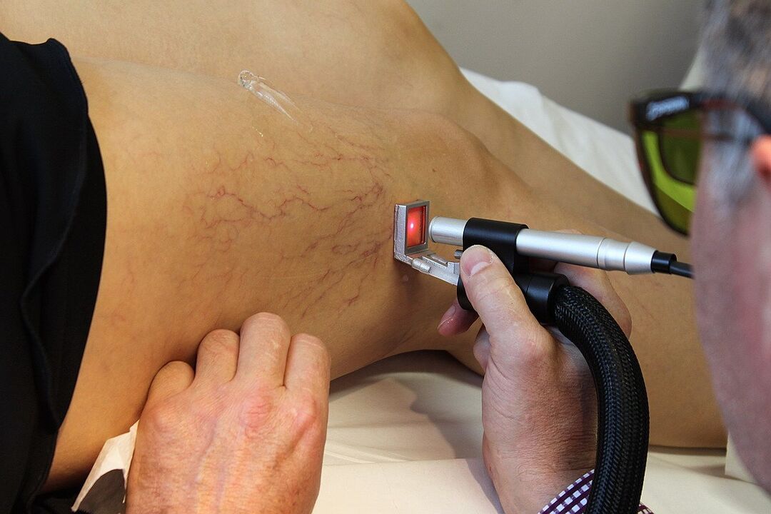 Freezing of laser