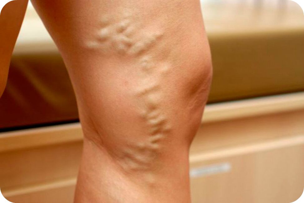 Vein varicose veins