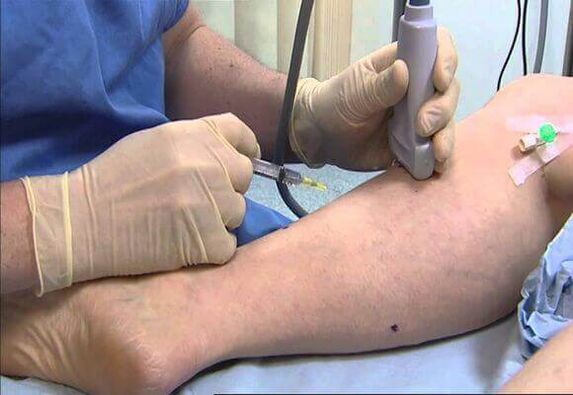 Varicose vein treatment