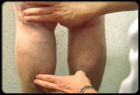 The doctor examines the feet with varicose veins