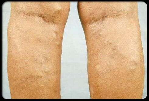 Varicose veins on the feet