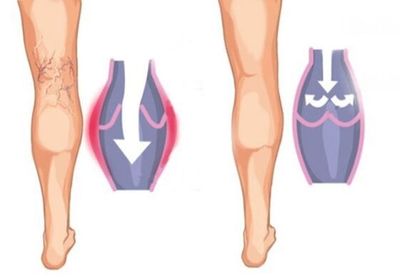 What varicose veins are like