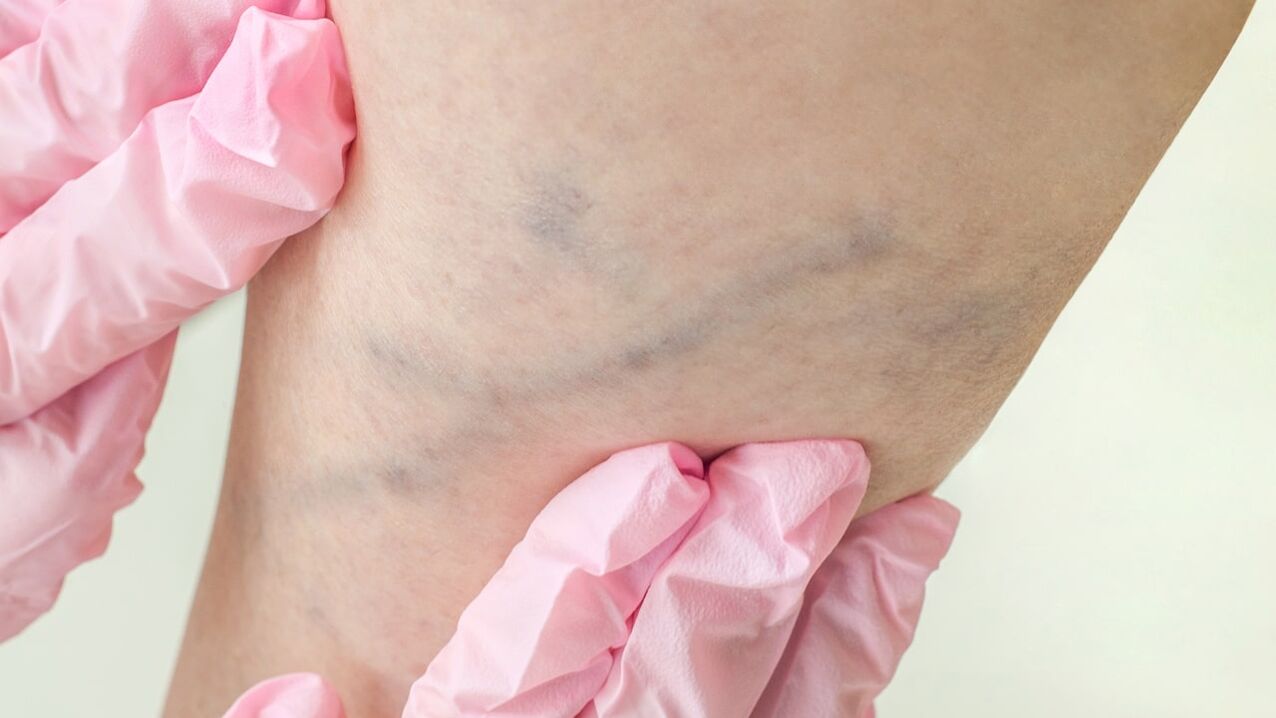 Varicose veins on the lower leg