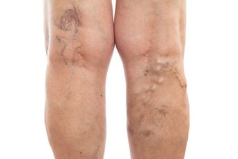 varicose veins on the lower leg