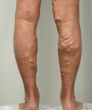 The 3-phase, varicose veins,