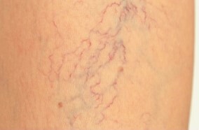 At the initial stage of varicose veins