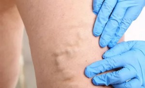 The treatment of varicose veins with the bioadhesive