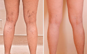Sclerotherapy before-and-after -